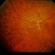 Idiopathic Pre-Retinal Membrane / Vitritis Idiopathic Pre-Retinal Membrane / Vitritis