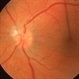 ILM Striae fFollowing Laser PRP