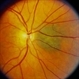 Choroidal Melanocytosis