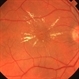 Macular Star Secondary to CNVM Macular Star Secondary to CNVM