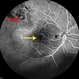 Radiation Retinopathy Radiation Retinopathy