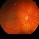 Macular Hole With Trapped Gas Bubble Macular Hole With Trapped Gas Bubble