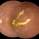 Leaking Aneurysms in Diabetic Retinopathy Leaking Aneurysms in Diabetic Retinopathy
