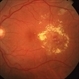 Circinate Ring in Diabetic Retinopathy Circinate Ring in Diabetic Retinopathy