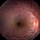 Congenital Vascular Tortuosity Congenital Vascular Tortuosity