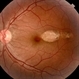 Torpedo Maculopathy Torpedo Maculopathy
