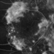 PROLIFERATIVE DIABETIC RETINOPATHY PROLIFERATIVE DIABETIC RETINOPATHY