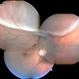 Fresh Superior Macula-On Rhegmatogenous Retinal Detachment Fresh Superior Macula-On Rhegmatogenous Retinal Detachment