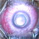 Microspherophakia Microspherophakia
