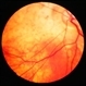 Linear Nevus Sebaceous Syndrome Linear Nevus Sebaceous Syndrome