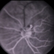 Autosomal Dominant Preretinal Vascular Loops Autosomal Dominant Preretinal Vascular Loops