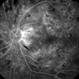 Severe NPDR