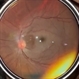 Central retinal artery occlusion