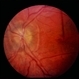 Pseudotumor Cerebri Pseudotumor Cerebri