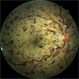 Right Central Retinal Vein Occlusion Right Central Retinal Vein Occlusion