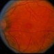 Macular Hole Evolving / Lamellar Hole Macular Hole Evolving / Lamellar Hole