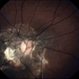 Optic Nerve Head Avulsion Optic Nerve Head Avulsion