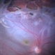 Recurrent Retinal Detachment with PVR with Subretinal Oil after Retinal Detachment with Silicone Oil Recurrent Retinal Detachment with PVR with Subretinal Oil after Retinal Detachment with Silicone Oil