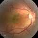 Papillomacular Fold in Posterior Microphthalmos