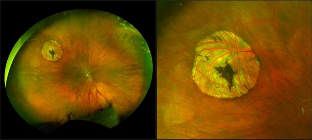 Left Operculated Hole Operculated Retinal Hole In Retinal Detachment Retina