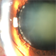 Iatrogenic Damage to the Lens Caused By Excessive Laser