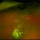 Small Gas Bubble within Coloboma Small Gas Bubble within Coloboma