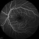Old Macular BRVO Old Macular BRVO