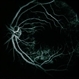 Scleritis / OIS Scleritis / OIS