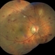 Hypertensive Retinopathy Hypertensive Retinopathy