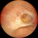 Retinoschisis Retinoschisis