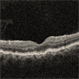 RE-OCT in Choroidal Detachment RE-OCT in Choroidal Detachment