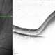 Macroaneurysm - OCT Macroaneurysm - OCT
