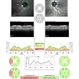 RNFL in Right Optic Disc Pit RNFL in Right Optic Disc Pit