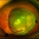 Retinoblastoma Without Vitreous Seeding Retinoblastoma Without Vitreous Seeding