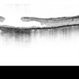 Lamellar Macular Hole Lamellar Macular Hole