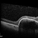 Tilted Disc Syndrome Complicated with RPE Atrophy and Polypoidal Choroidal Vasculopathy Tilted Disc Syndrome Complicated with RPE Atrophy and Polypoidal Choroidal Vasculopathy