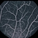 Multiple Sclerosis