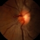 Prepapillary Vascular Loop Prepapillary Vascular Loop