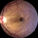 Traumatic Macular Hole Traumatic Macular Hole