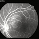 Choroidal Hemangioma Choroidal Hemangioma