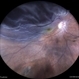 Superior Retinal Detachment Superior Retinal Detachment