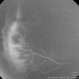 Stage 3 Retinopathy of Prematurity Stage 3 Retinopathy of Prematurity
