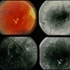 Myopia Myopia