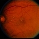 BDR / Macular Edema / Macroaneurysm BDR / Macular Edema / Macroaneurysm