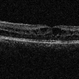 X-Linked Retinoschisis X-Linked Retinoschisis
