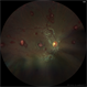 Leukemic Retinopathy - OD