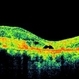 Perifoveal Telangiectasia With CNVM Perifoveal Telangiectasia With CNVM
