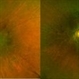 Retinitis Pigmentosa Retinitis Pigmentosa