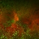 Asteroid Hyalosis in Retinitis Pigmentosa Asteroid Hyalosis in Retinitis Pigmentosa