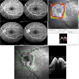 Optic Nerve Head Drusen Optic Nerve Head Drusen